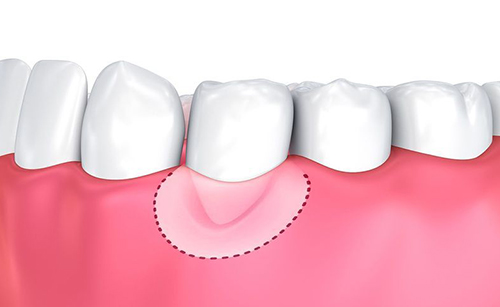 Gum surgery - Cameron Dental Center